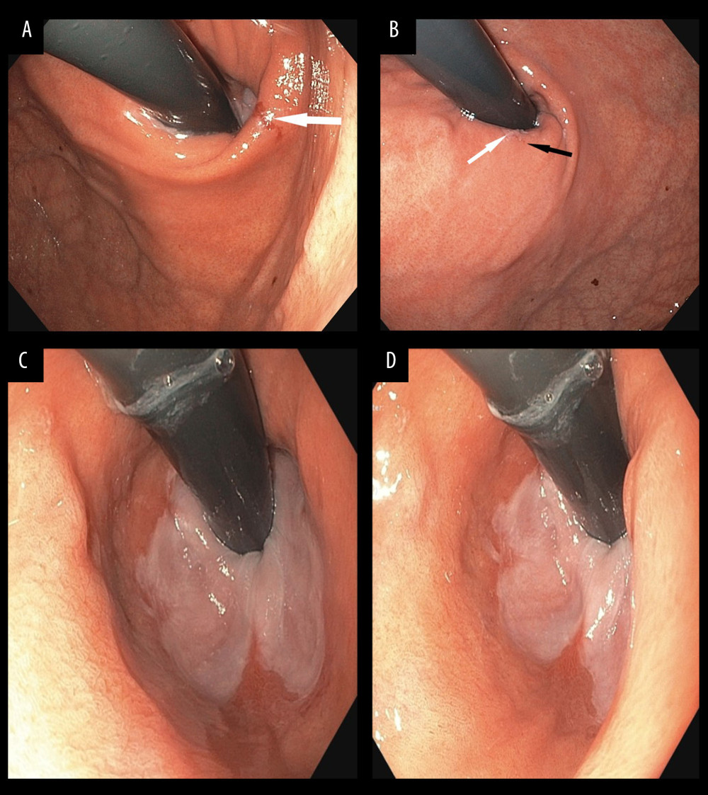 (A) Our patient’s Cameron erosion at the time of diagnosis establishment. During the initial gastroscopy, the Cameron erosion presented as a linear mucosal defect (white arrow). After partial gas desufflation the volume and diameter of the sliding hiatal hernia were reduced to provide a better presentation of the lesion and enable sampling. On the left middle and lower part of the image and on the lower right part of the image one can recognize several hematin spots. (B) Our patient’s Cameron erosion during the second (first follow-up) gastroscopy. The left half of the erosion (white arrow) is covered by fibrin, and the right half (black arrow) showed inflammatory alterations (microscopically red mucosa). There are several hematin spots on the middle and lower right side of the image. (C) Image from the last (second follow-up) gastroscopy with maximal gas insufflation. The Cameron erosion is resolved. (D) Image from the last (second follow-up) gastroscopy with maximal gas insufflation. The Cameron erosion is resolved.