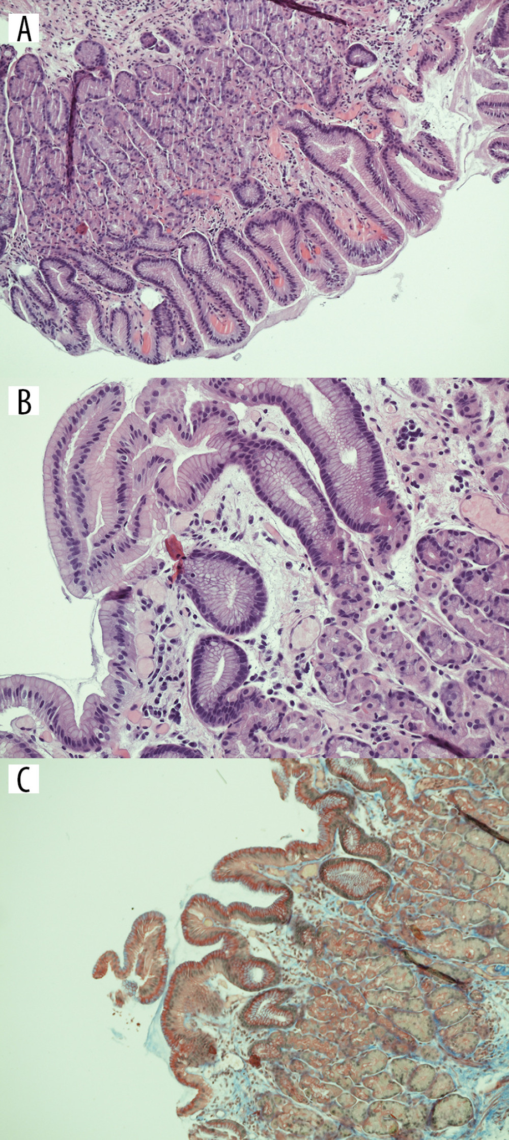 (A) Microscopic image (HE, magnification ×100) from the second tissue sampling: oxyntocardiac mucosa with minimal foveolar hyperplasia. HE: Hematoxylin and eosin staining. (B) Microscopic image (HE, magnification ×200) from the second tissue sampling: focal minor active inflammatory infiltrates in lamina propria with a slight edema and dilated capillaries. No ischemic stigmata were present. (C) Microscopic image (CAB, magnification x100) from the second tissue sampling: a minimal fibrosis in lamina propria in a single localized area. HP was not detectable. CAB – chromotrope aniline blue staining; HP – Helicobacter pylori.