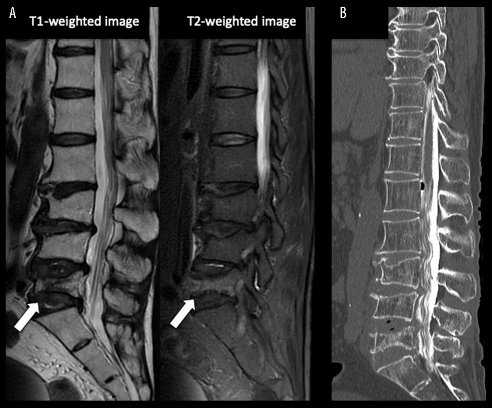 (A) Sagittal lumbar magnetic resonance image displaying a fracture with associated edema on L5. The arrow indicates the fracture. (B) Sagittal computed tomography myelography did not show compressive lesions pressing against the nerve roots and spinal cord.