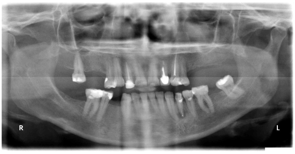 Panoramic image acquired for the initial assessment of implant sites.