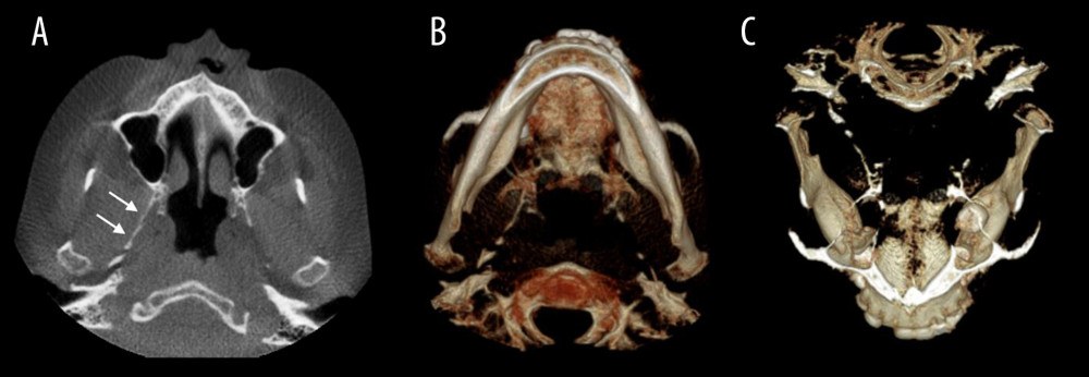 (A) Axial and (B) 3D rendering inferior view of CBCT images demonstrating the presence of pterygospinous ligament ossification extending from the right lateral pterygoid plate (white arrows). (C) 3D rendering superior view CBCT image showing the most superior aspect of the CBCT volume acquired.