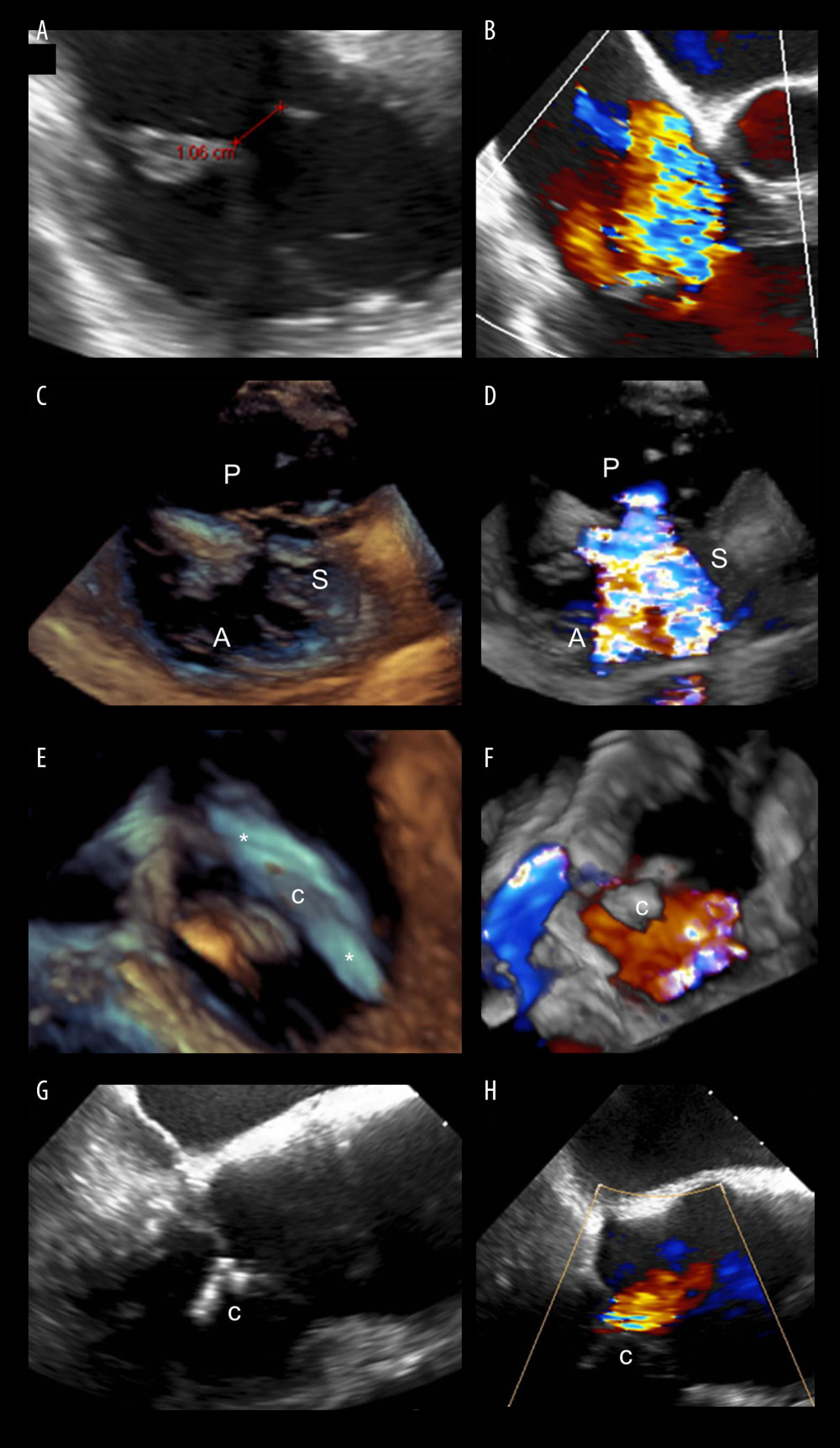 Intraprocedural images of the percutaneous edge-to-edge tricuspid valve repair employing the MitraClip XTR system by transesophageal echocardiography (TEE). (A–D) TEE revealed severe tricuspid valve regurgitation between the anterior and the septal and the posterior and the septal leaflet, coaptation gap size 10.6 mm (A: Mid-esophageal 4 chamber view, B: Corresponding color Doppler imaging, C: Transgastric 3D imaging of tricuspid valve, D: Corresponding color Doppler imaging visualizing origin of TR). (E, F) TEE-view for correct clip rotation of the MitraClip XTR system (E: 3D imaging of clip for correct rotation. F: Corresponding color Doppler imaging, (G, H), After implantation of 2 XTR clips, we achieved significant reduction of TR, with a mild-to-moderate residual TR, Pmean 3 mmHg (G: Mid-esophageal 4 chamber view with XTR clips in final position, H: Corresponding color Doppler imaging). TR – tricuspid regurgitation; S – septal leaflet; A - anterior leaflet; P – posterior leaflet; c – clip, * clip arms.