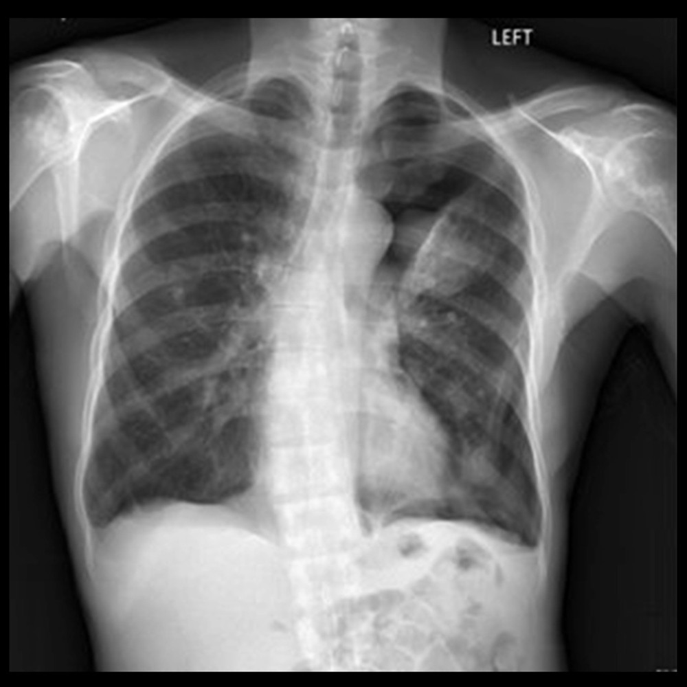 Chest X-ray showing a large left-sided pneumothorax with some associated pleural fluid, left upper-lobe opacity, and round opacity in the anterior aspect of the right upper lobe.