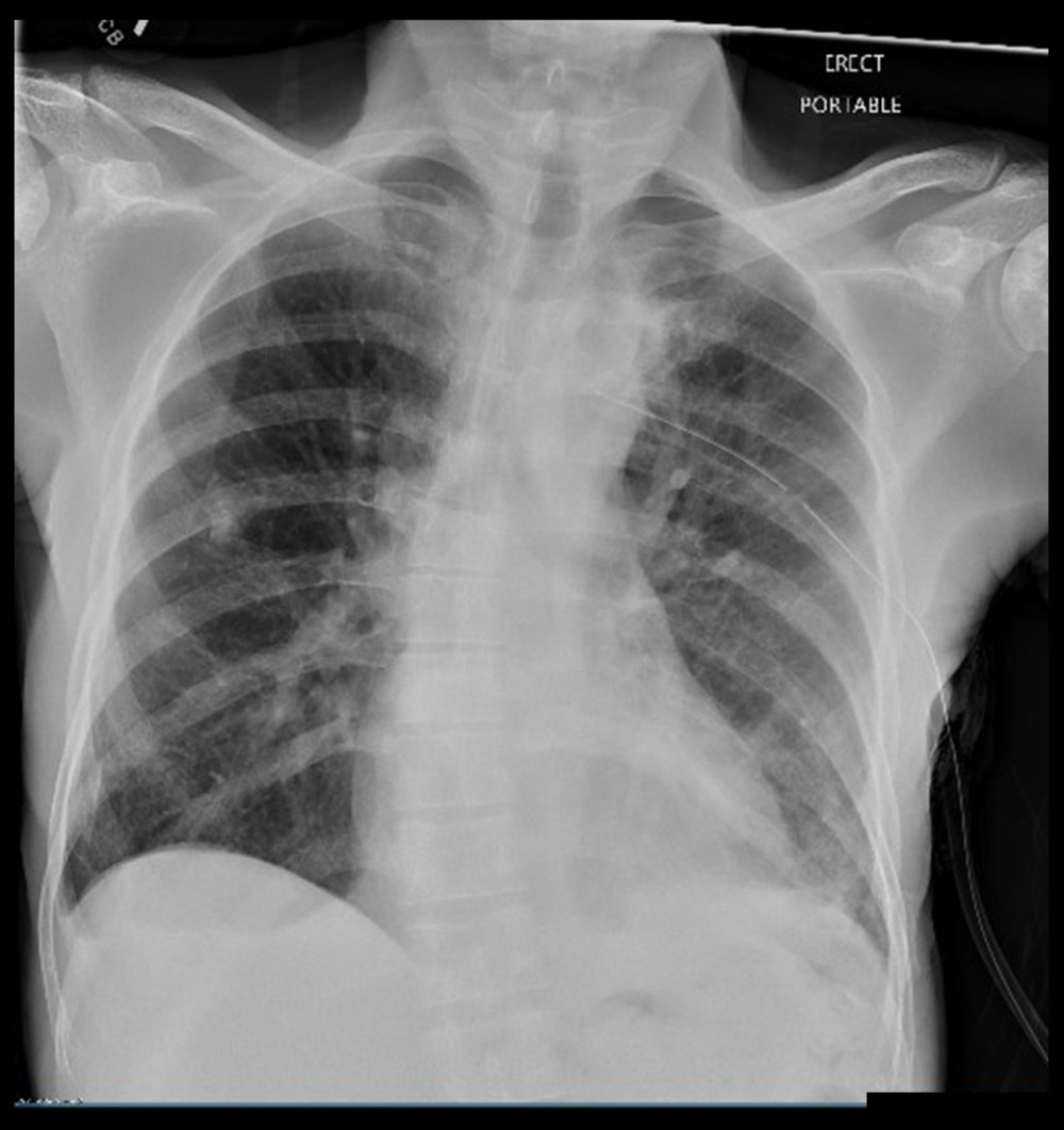 Chest X-ray showing resolution of the pneumothorax after chest tube placement.