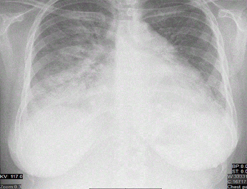 Chest radiograph at admission. Chest X-ray revealed cardiomegaly, increased vascular marking, congested lung fields, and cephalization of pulmonary vasculature, in addition to right middle- and lower-lobe patchy opacities.