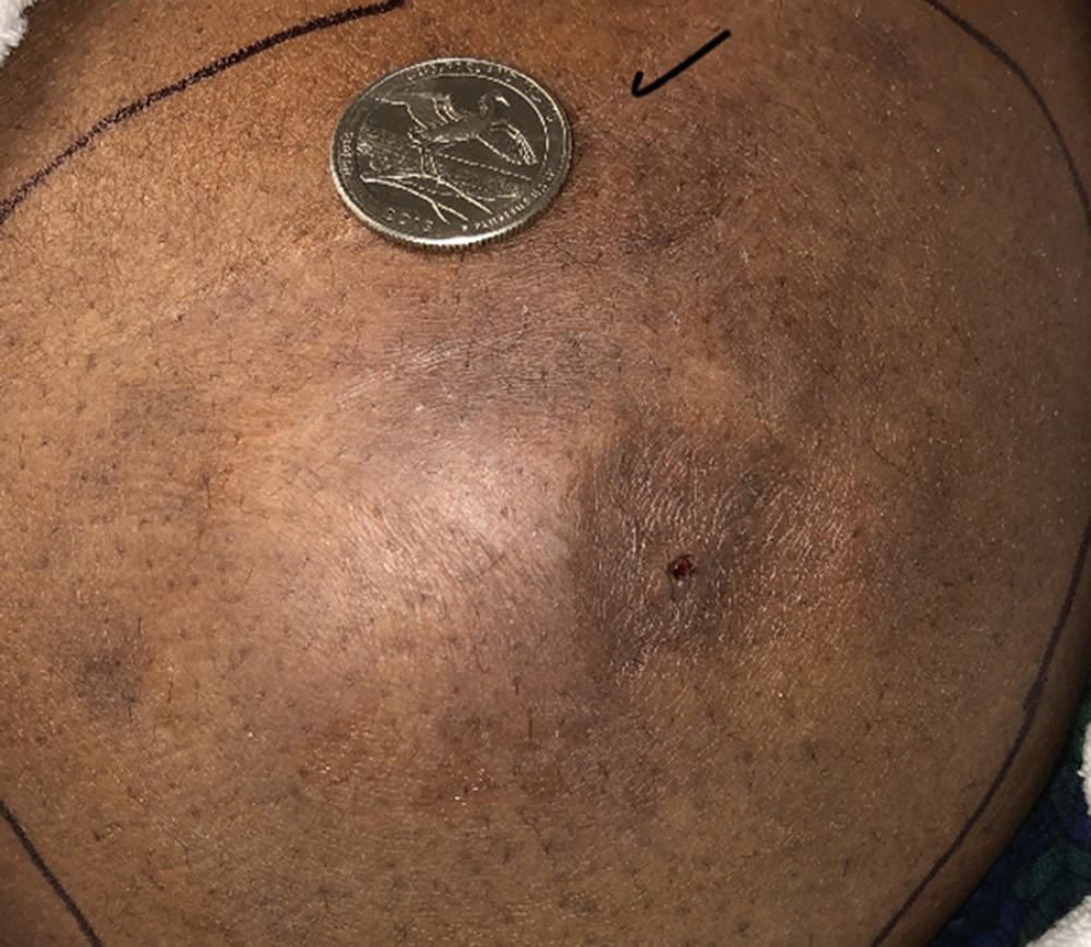 Photograph of the metastatic lesion on the right gluteal mass. A flesh-tone, discrete, firm, immobile, non-erythematous, and non-ulcerative nodule measuring 10×5 cm.