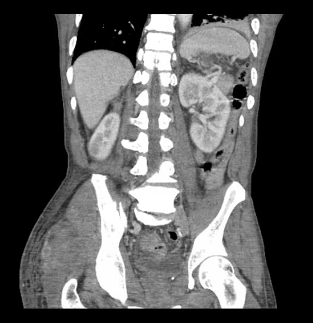 Coronal view computed tomography (CT) abdomen and pelvis with contrast showing right-buttock solid 6.7-cm mass with adjacent subcutaneous edema indenting the gluteus muscle and bilateral adrenal and renal masses.