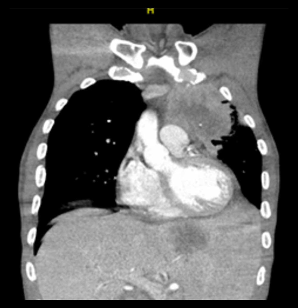 Coronal view CT chest showing 10.3×7.9×9.3 cm left upper-lobe poorly defined mass with central necrosis and calcification with the obstruction of the left upper-lobe bronchus, and a 6.3-cm left hepatic-lobe mass with peripheral nodular enhancement.