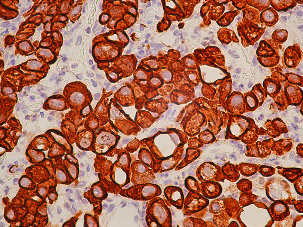 Gluteal mass biopsy (immunohistochemistry, magnification ×400) showing tumor cells are strongly immunoreactive to cytokeratin 7 (CK 7).