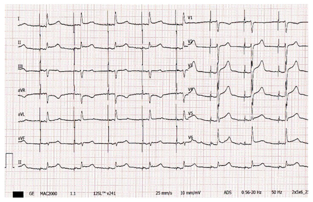 Electrocardiography 1 day after the IPG implantation.
