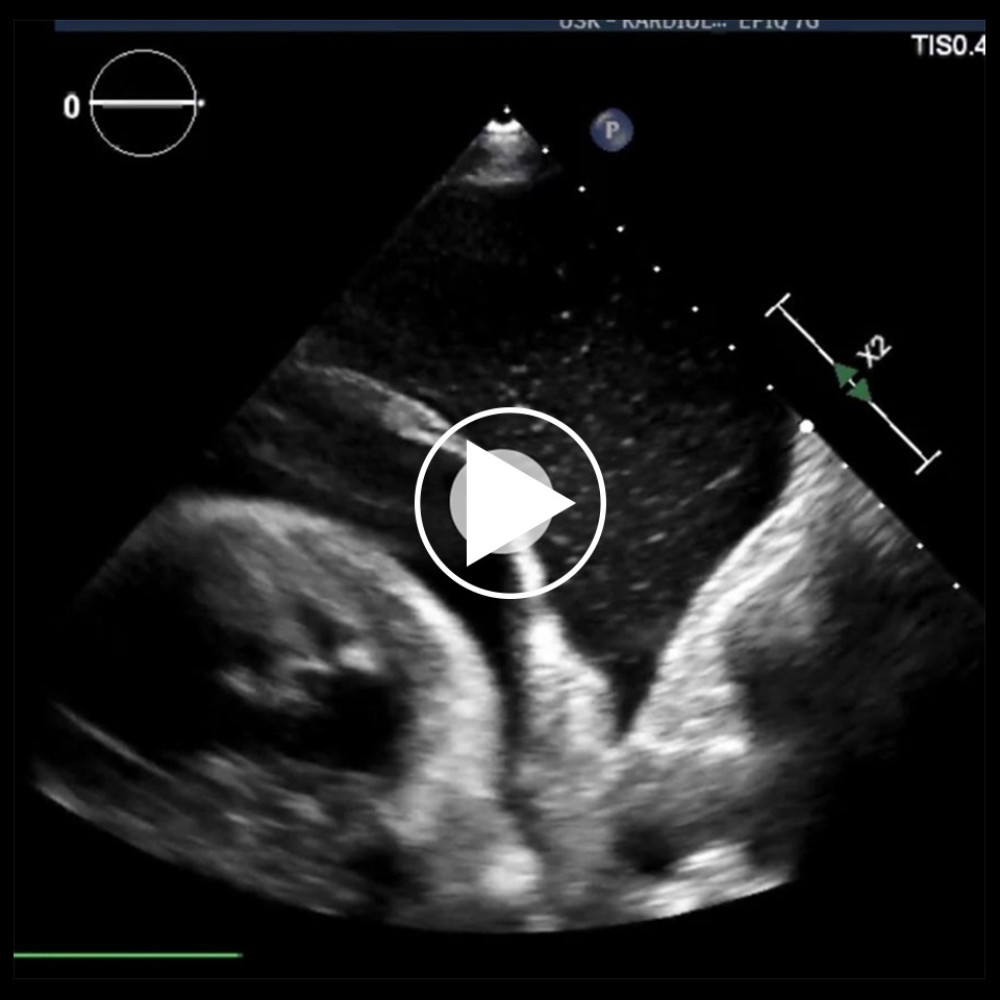 Lung ultrasound displaying a left pleural effusion and pericardial effusion.