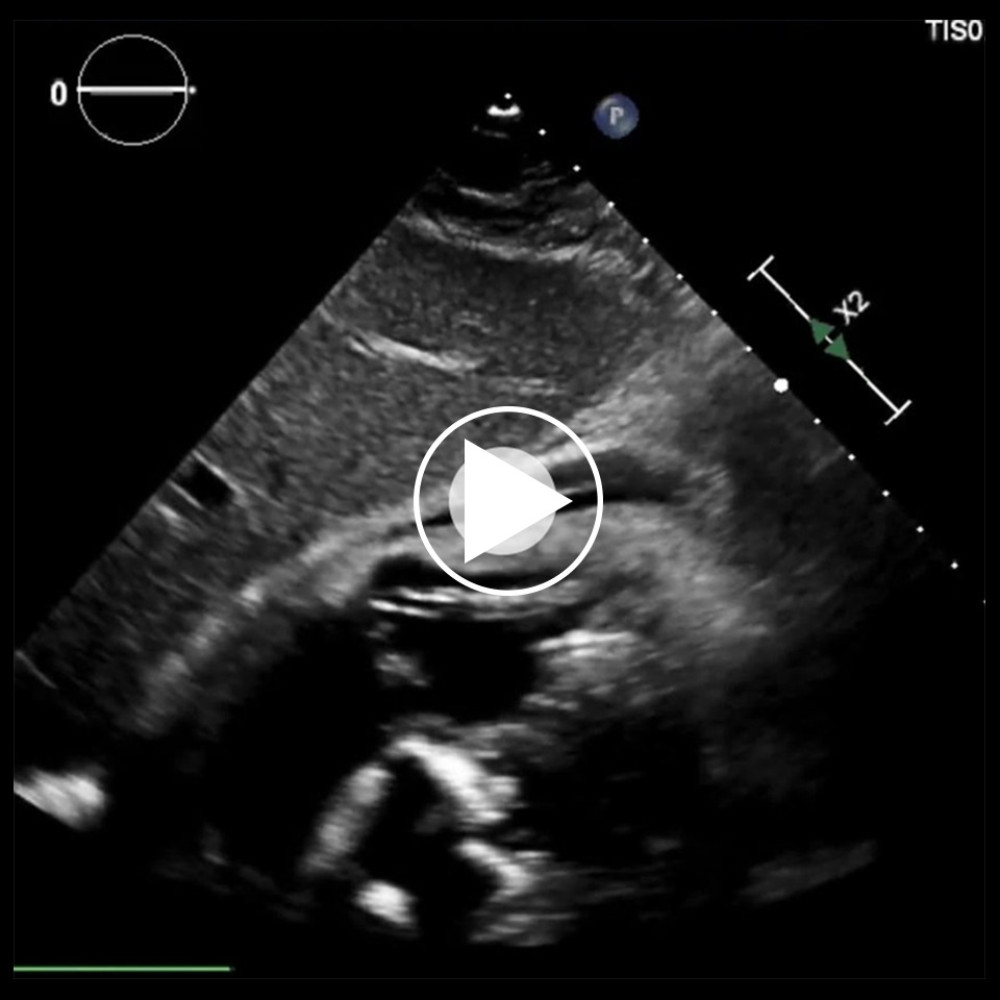 Echocardiographic subcostal view displaying a small amount of fluid in front of the right ventricle.