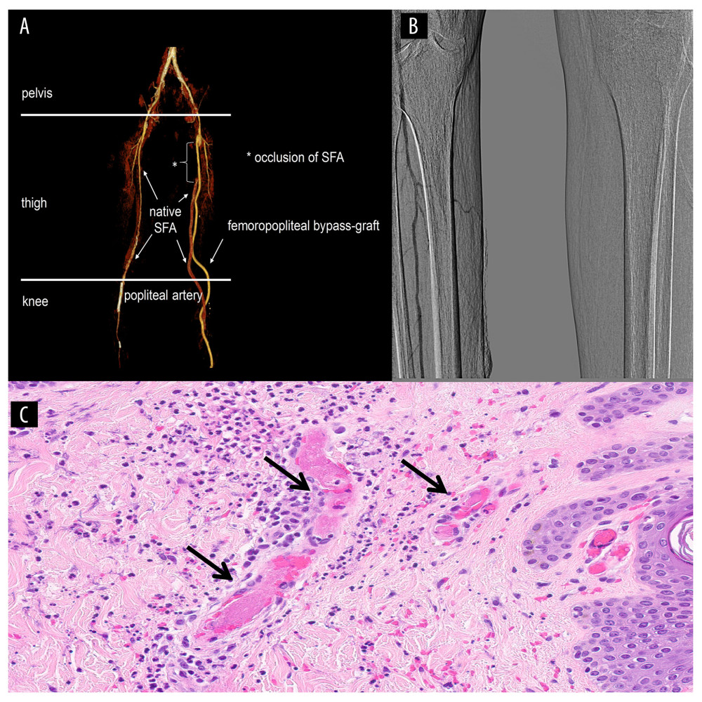 CT-Scan and angiography of lower extremities and HE-staining of affected lesions. CT-scan shows serial stenoses of the right femoral, popliteal, anterior, and posterior tibial artery. The left-sided femoropopliteal bypass graft was occluded (A). Angiography shows reduced perfusion of the left-sided distal lower leg (B). HE-staining (40×) shows interstitial inflammation of the corium with neutrophilic inflammation and occlusion of the vasculature (arrows) (C).