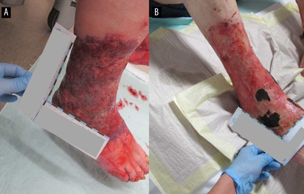 Photographs of the ulcerations upon initial presentation and before discharge. Ulcerations of the right leg upon initial presentation (A) and before discharge after therapy induction (B).