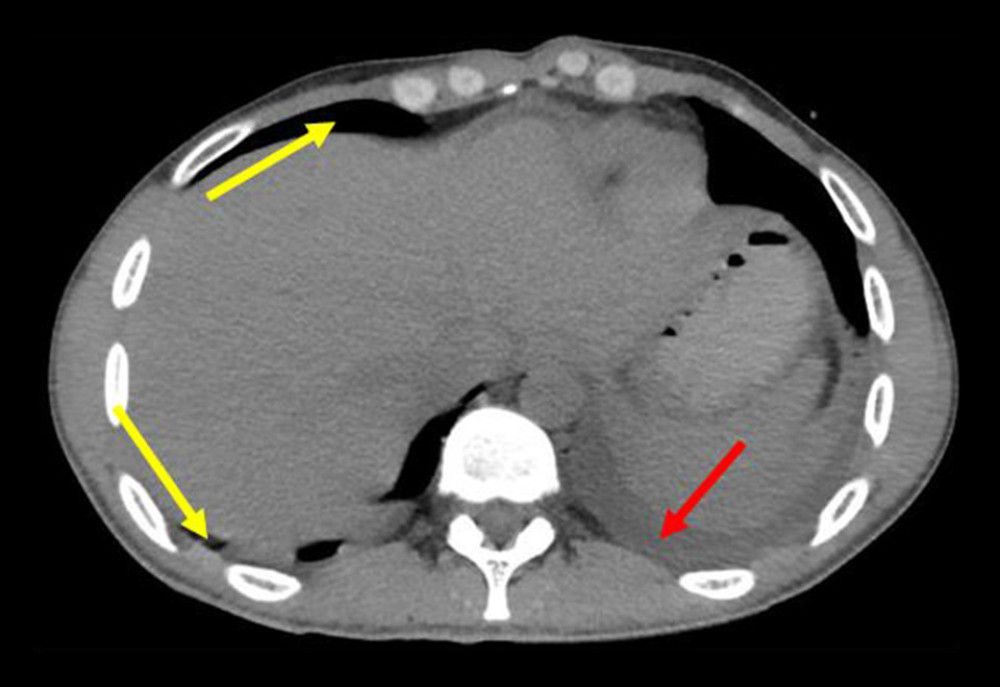 Abdominal CT scan before surgery showing free intraabdominal fluid on the posterior side (red arrow) and free extra-peritoneum air on anterior and posterior sides (yellow arrows) caused by abdominal perforation.