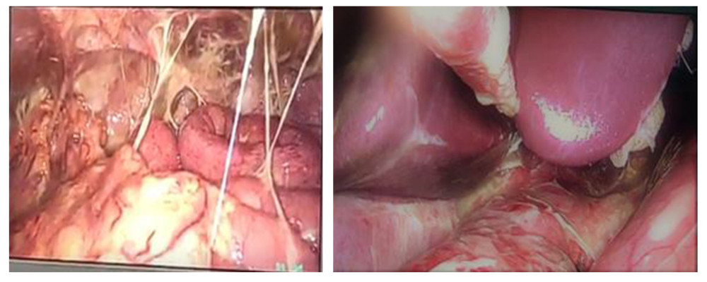 Intraabdominal laparoscopy showing abdominal purulent fluids, fibrin, and pseudomembranes of a patient with gastric perforation and oral expulsion of Taenia saginata.