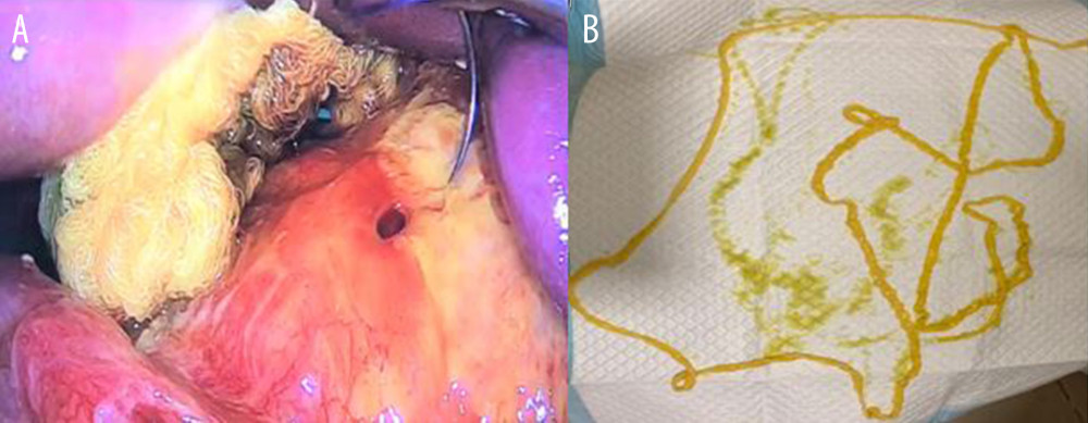 Stomach perforation (A) in a 27-year-old Lebanese man with a history of smoking and Taenia saginata infection that was expelled orally (B).