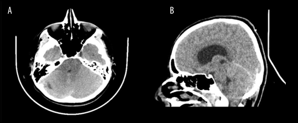 Brain CT. Axial (A) and sagittal (B) CT scan at initial presentation showed asymmetric enlarged left cerebellar hemisphere causing mass effect upon the fourth ventricle showing right-sided displacement with effacement of basal cisterns as well as cerebellar tonsils herniation with obstructive hydrocephalus.