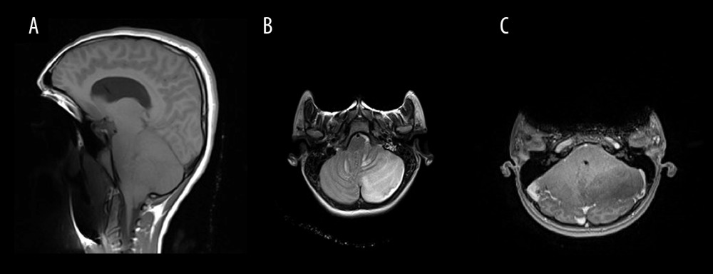 Brain MRI. Sagittal T1-weighted image (A), axial T2-weighted (B), and axial T1-weighted contrast-enhanced image (C) at initial presentation affected by susceptibility artifact of dental braces showed cerebellar tonsillar herniation and obstructive hydrocephalus, T2 hyper-intense signal of the cortex and white matter of left cerebellar hemisphere and medial right cerebellar medial focus with no leptomeningeal or parenchymal enhancement.