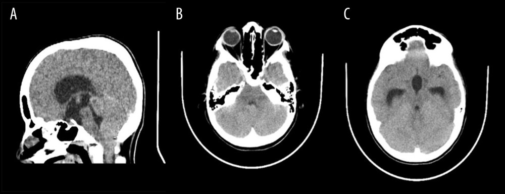 Brain CT. (A–C) Non-enhanced brain CT shows crowded foramen magnum due to tonsillar herniation with diffuse cerebellar swelling causing a compressed fourth ventricle and subsequent mild-to-moderate third and lateral ventricles dilatation. There is no abnormal density of the cerebellum or the brain stem, and no mass effect or midline shift.