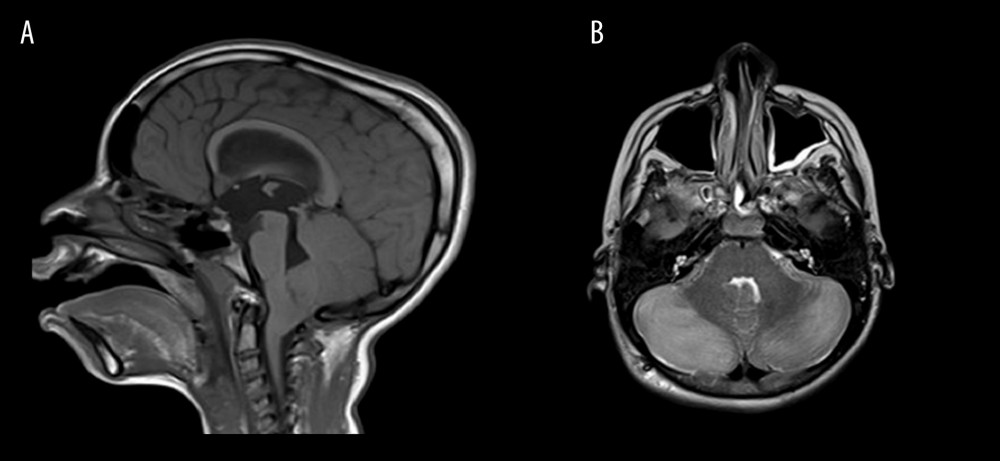 Follow-up MRI. Sagittal T1-weighted image (A), axial T2-weighted image (B) showing cerebellar tonsillar herniation with obstructed proximal hydrocephalus, and high T2 signals of both cerebellar hemispheres, with no diffusion restriction or abnormal enhancement.