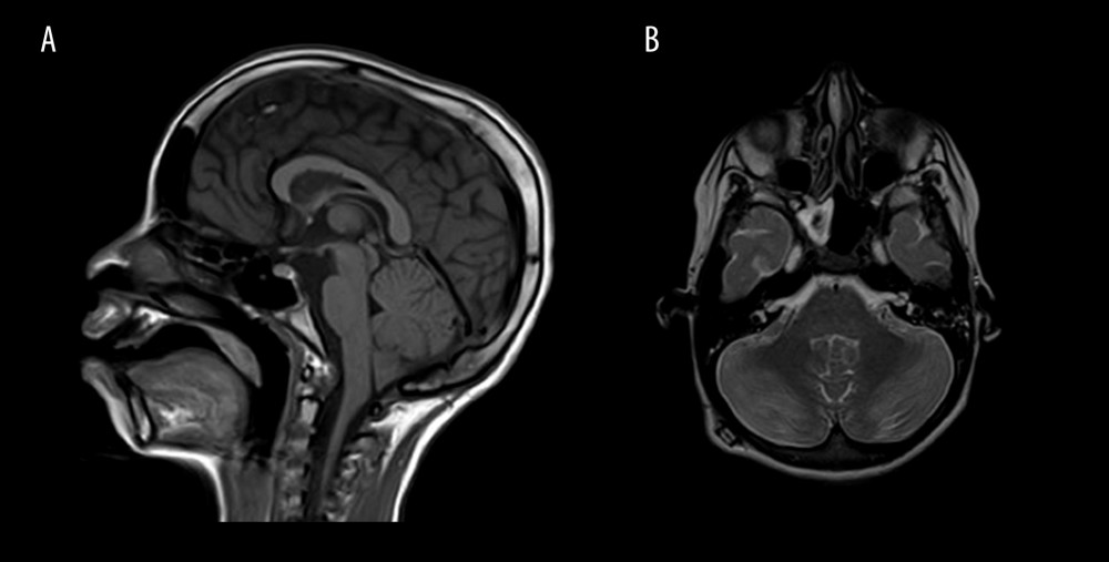 Follow-up brain MRI. Sagittal T1-weighted image (A) and axial T2-weighted image (B) 1 week later showed improvement of tonsillar herniation with resolved previous proximal hydrocephalus, and significant improvement of abnormal cerebellar hemispheres signals, with no hemorrhagic products.
