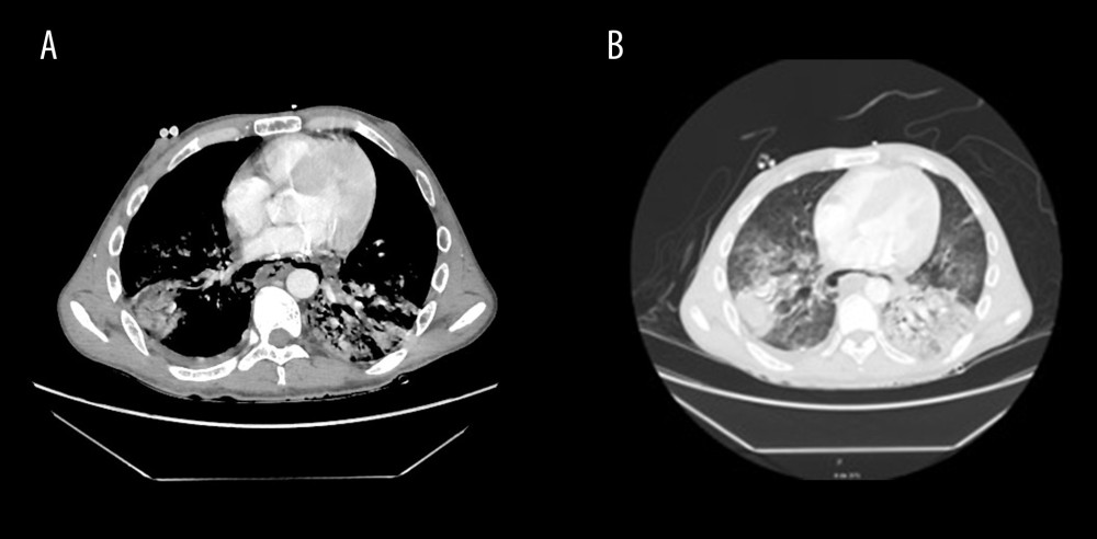 (A, B) Signs of posterior pneumomediastinum, with thickening of the walls of the distal third of the esophagus and consolidations of infectious appearance in both lung bases, associated with scarce bilateral pleural effusion.