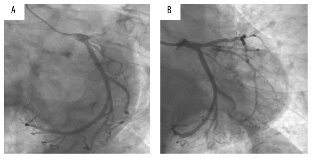 Left coronary angiography. (A) Emergent coronary angiogram showed total occlusion in the proximal left anterior descending artery. (B) Successful coronary angioplasty with a drug-eluting stent.