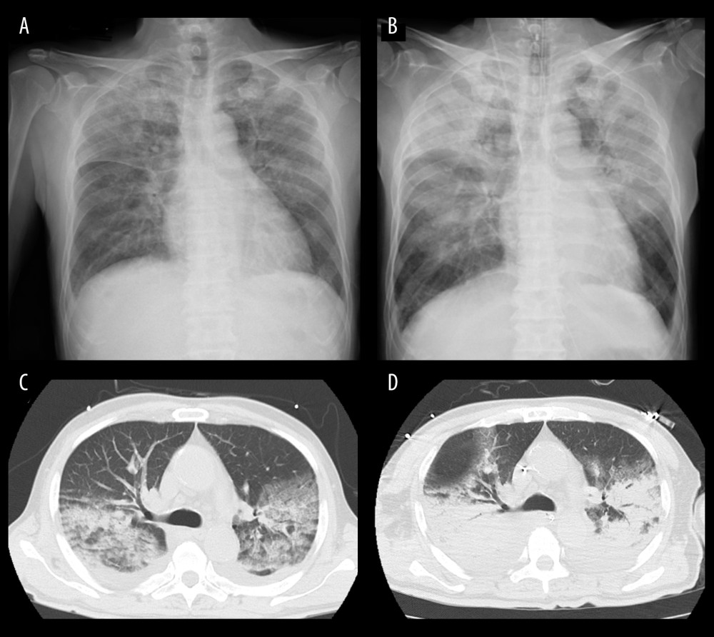 (A) The X-ray on day 5 showed decreased permeability in the pulmonary apex region predominance. (B) The decreased permeability worsened on day 7. (C) Chest computed tomography revealed ground-glass opacity with partial consolidation in the bilateral lung field on day 5. (D) The ground-glass opacity effect was even more pronounced on day 7.