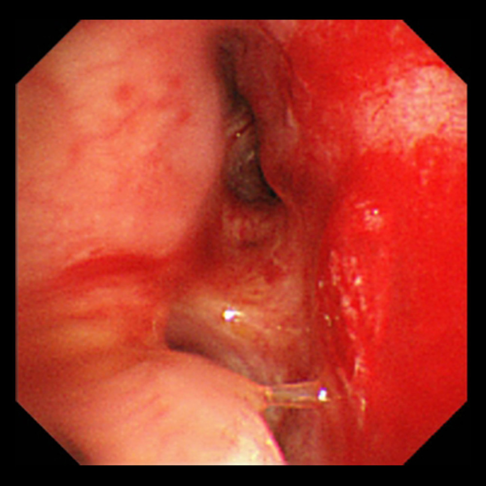 The bronchoscopy image at the time of hemoptysis on day 7. Intratracheal bleeding was observed.