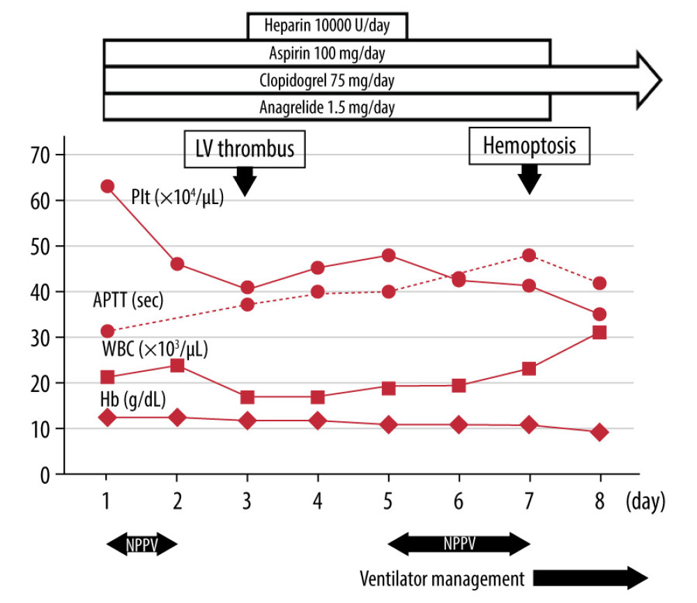 The clinical course of the patient after hospitalization. LV – left ventricular; Plt – platelets; APTT – activated partial thromboplastin time; WBC – white blood cells; Hb – hemoglobin; NPPV – noninvasive positive pressure ventilation.