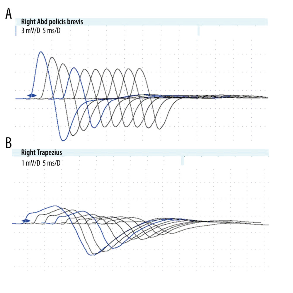 Result of the nerve conduction study performed on the right abductor pollicis brevis (A) and the right trapezius (B).