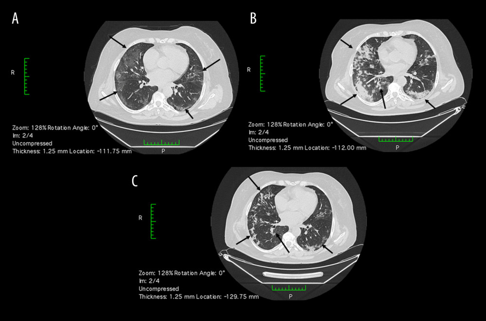 Case 1 lung CT images. (A) Initial CT scan, DOD (days from disease onset) 16, showing bilateral GGO (ground-glass opacities) in all lobes with rounded and linear morphology (arrows). (B) Followup CT scan, DOD 21, showing the development of GGO with a crazy-paving pattern and of bilateral consolidative opacities with vacuolar signs, with peripheral and central distribution (arrows). (C) Followup CT scan, DOD 27, showing consolidation areas and GGO sharply decreased after intervention (arrows). DOD – days from disease onset; GGO – ground-glass opacities.