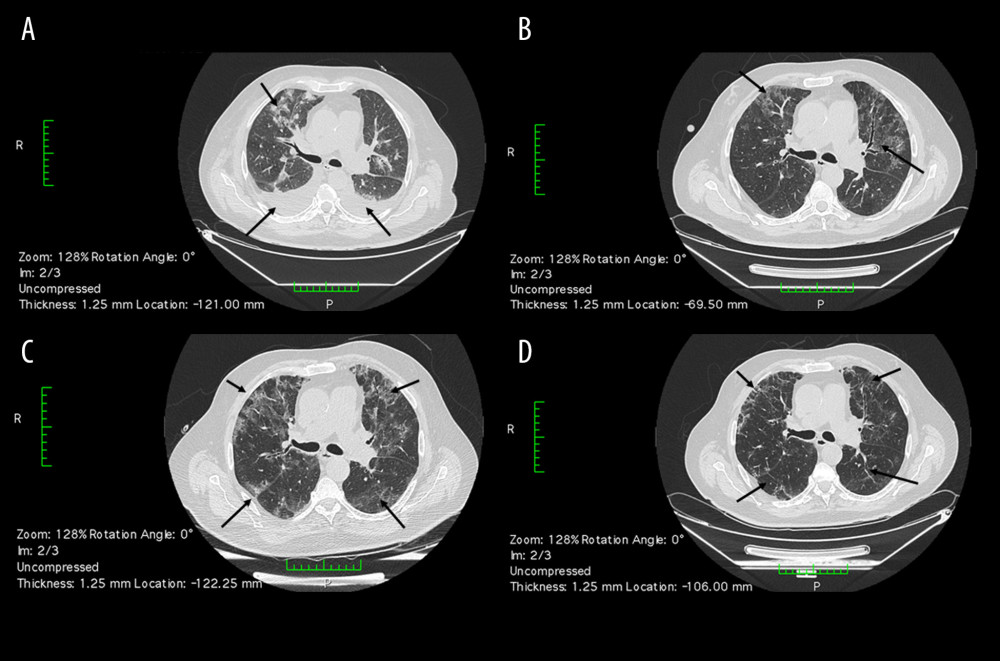 Case 2 lung CT images. (A) Initial CT scan, DOD 11 showing bilateral GGO with pleural effusions and interstitial edema (arrows). (B) Followup CT scan, DOD 18, showing bilateral GGO with reticular changes with peripheral and central distribution pattern (arrows). (C) Followup CT scan, DOD 25, showing bilateral extended areas of GGO with reticular pattern and consolidations (arrows). (D) Followup CT scan, DOD 31, showing resolution of severe bilateral GGO and consolidations after intervention (arrows). GGO – ground-glass opacities; DOD – days from disease onset.