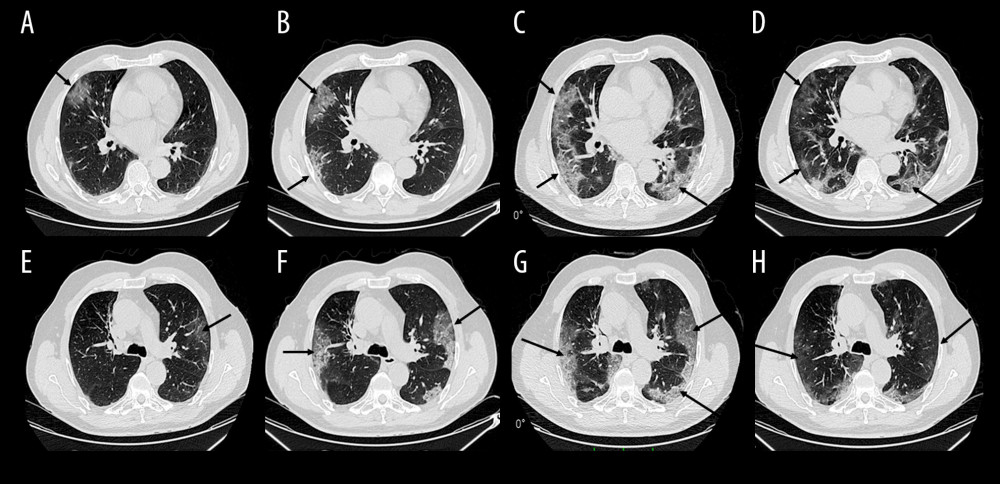 Case 3 lung CT images. (A, E) Initial CT scan, DOD 12 showing round GGO and bilateral linear opacities (arrows). (B, F) Followup CT scan, DOD 16, showing deterioration of GGO into bilateral striking reticular changes of peripheral and central distribution with a crazy-paving pattern (arrows). (C, G) Followup CT scan, DOD 18, showing extension of GGO and deterioration into bilateral consolidations (arrows). (D, H) Followup CT scan, DOD 23, showing decreased area and intensity of bilateral consolidations and decreased GGO with appearance of fibrous stripes (arrows). GGO – ground-glass opacities; DOD – days from disease onset.