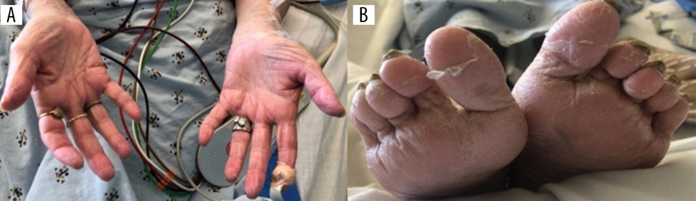Images showing bilateral peeling of the skin on the patient’s A: hands and B: feet, which is a common finding associated with severe acute malnutrition or kwashiorkor disease.