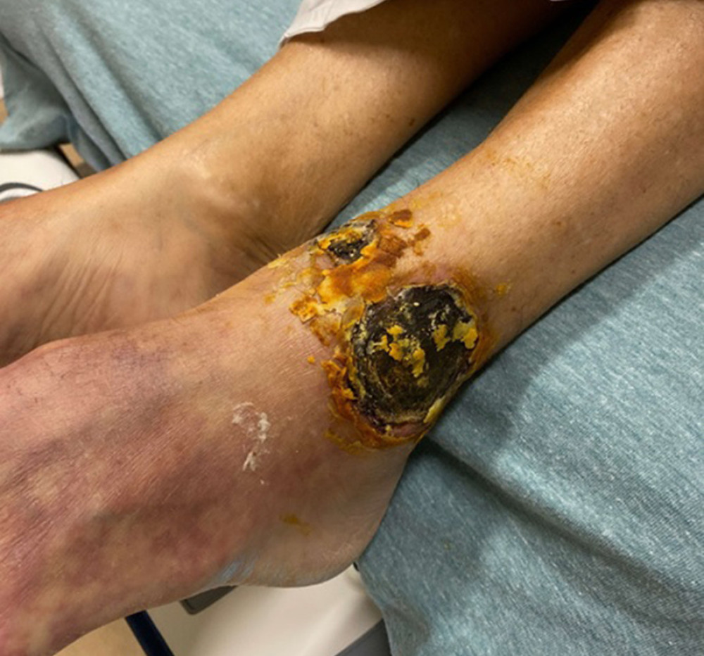 Wound overlying the lateral aspect of the left ankle.