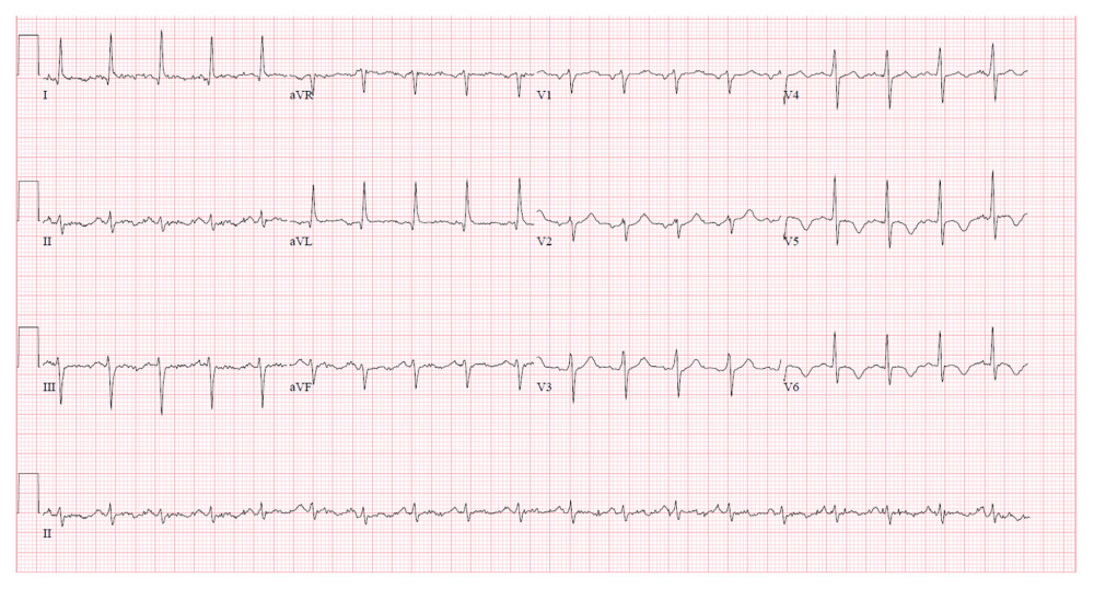 Electrocardiogram showing sinus tachycardia and T wave inversions in anterolateral leads.