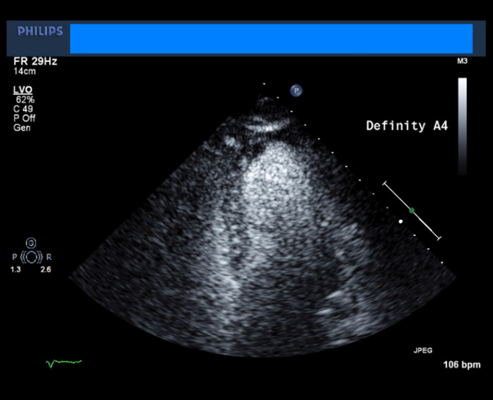 Transthoracic echocardiogram showing mid- to apical anterolateral hypokinesis.