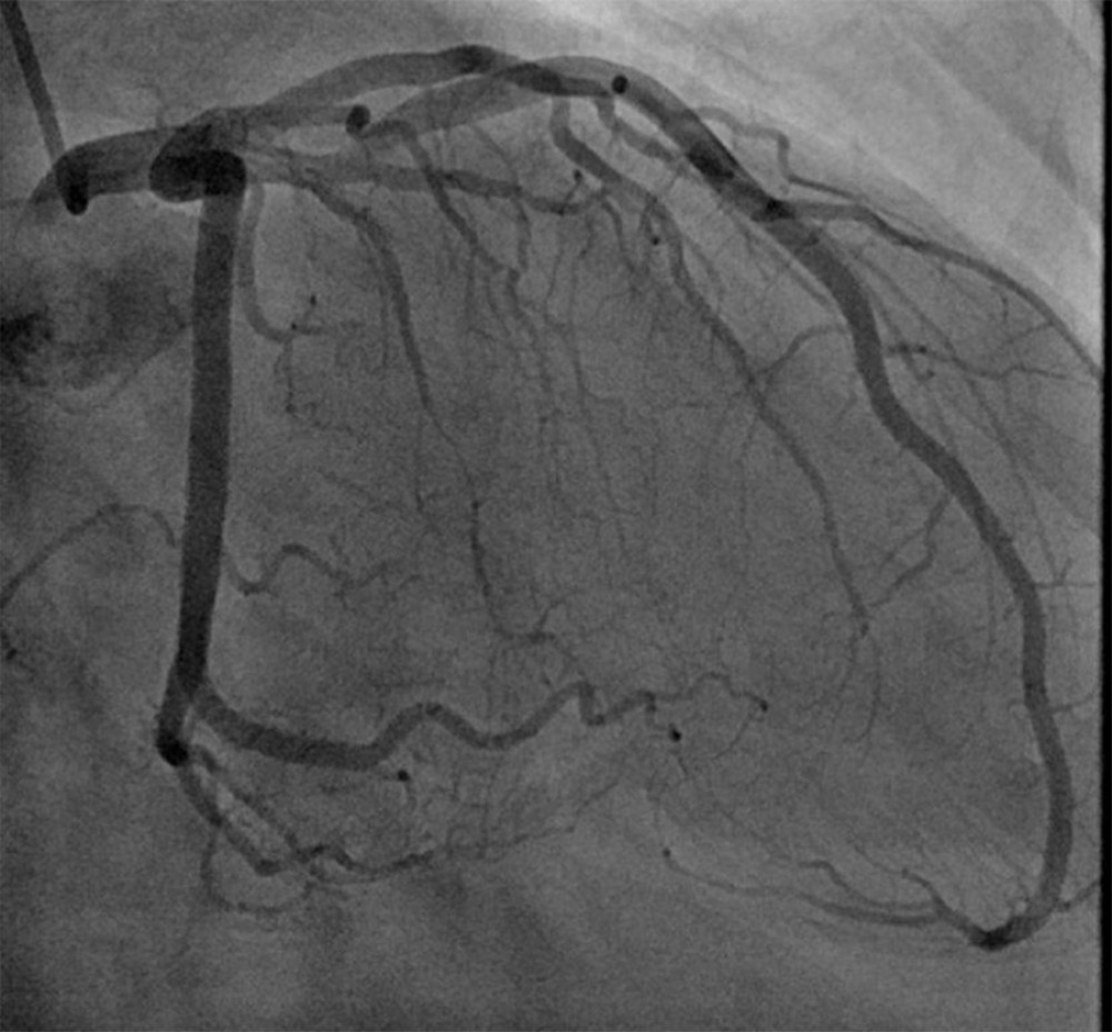 Left heart catheterization showing widely patent coronary arteries.