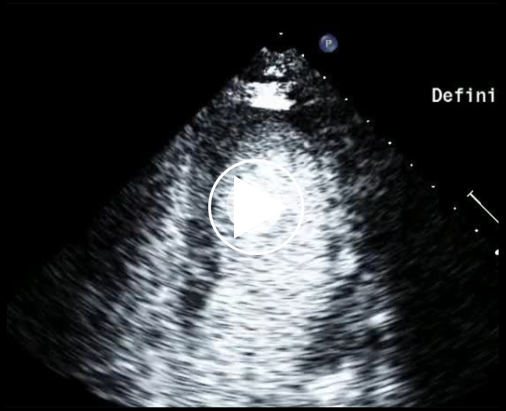 Transthoracic echocardiogram with Definity showing mid- to apical anterolateral, mid-apically anteroseptal, mid- to apical anterior, apical marked hypokinesis, with no obvious thrombus.