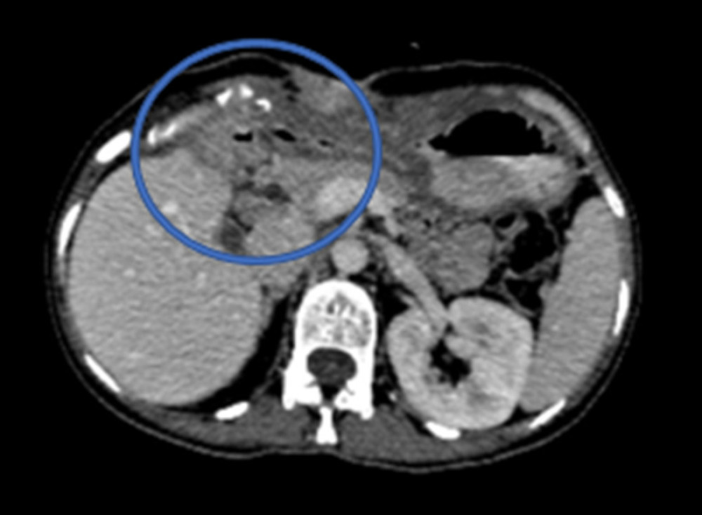 The circle shows the fistula tract and subcutaneous abscess cavity filled with air and oral contrast material.