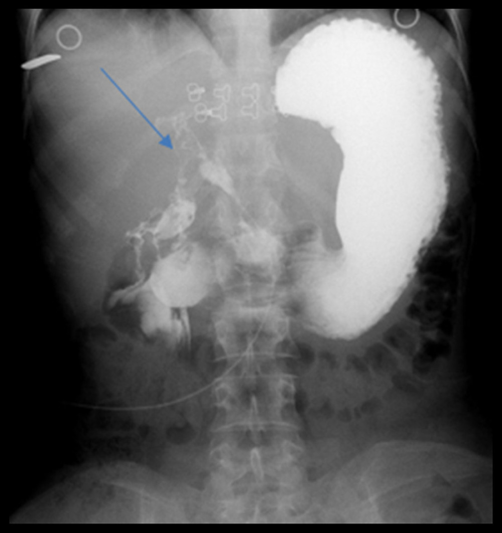 The arrow shows that the fistula tract originates from the first part of the duodenum.