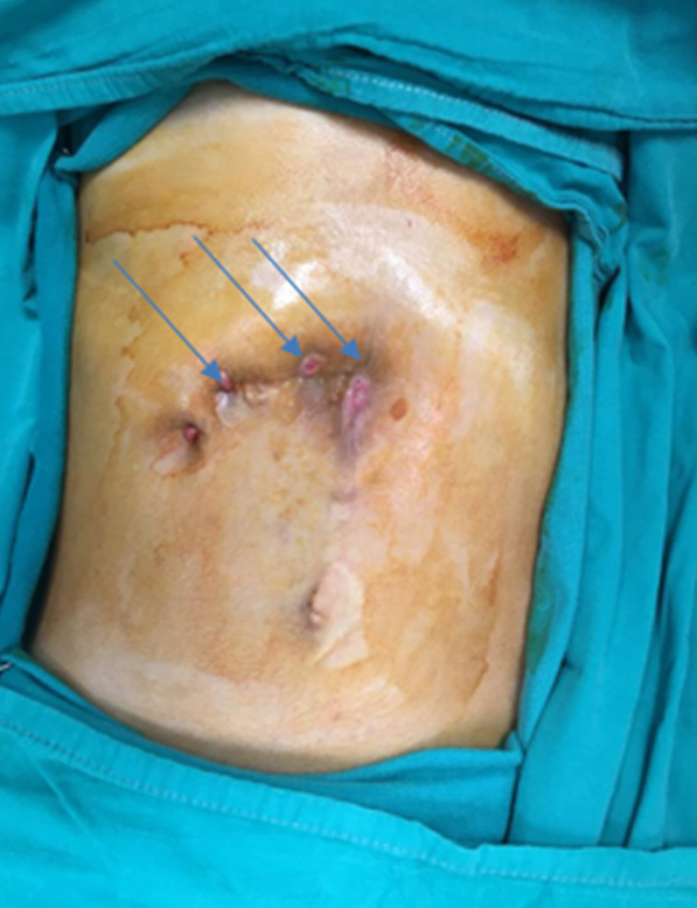 The arrows show the fistula openings.