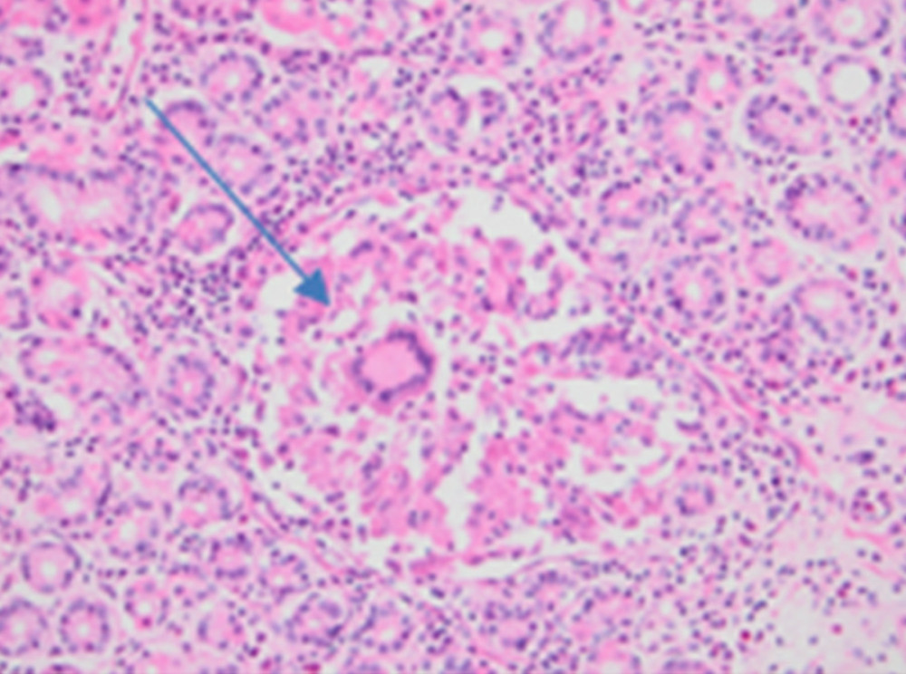 The arrow shows non-necrotizing granulom in a stomach sample.