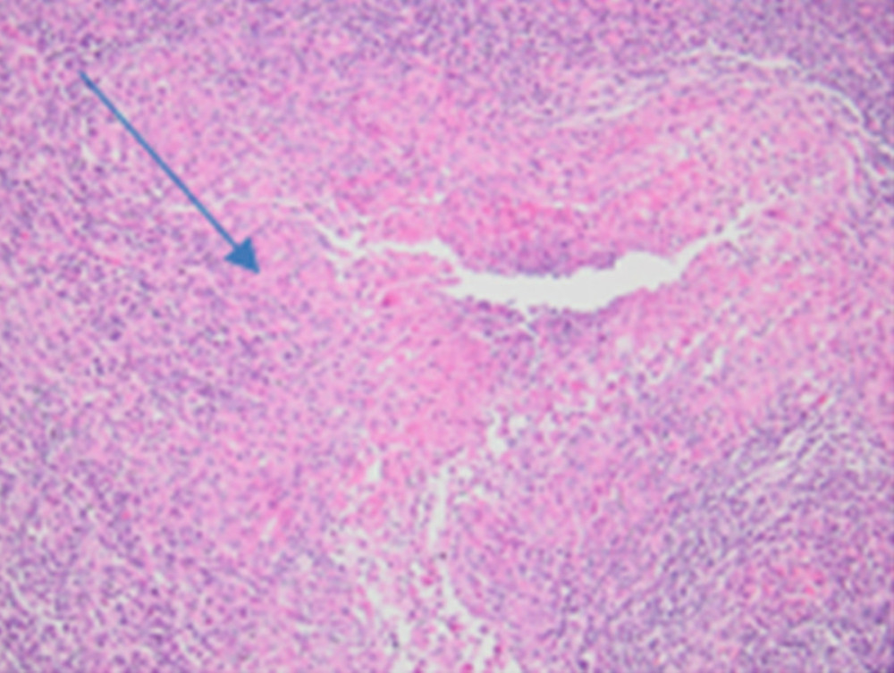 The arrow shows lymph node specimen granuloma with central necrosis.