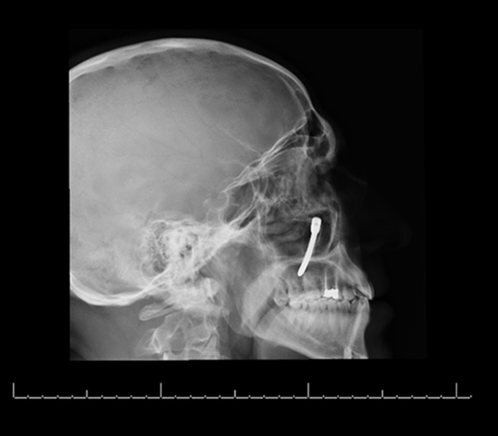 Lateral plain X-ray of the head shows abnormal curved radio-opaque shadow (metallic object).