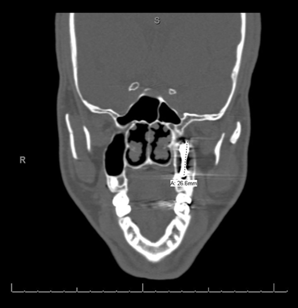 CT scan of the sinuses, coronal view, shows a large dense foreign body in the left maxillary sinus.