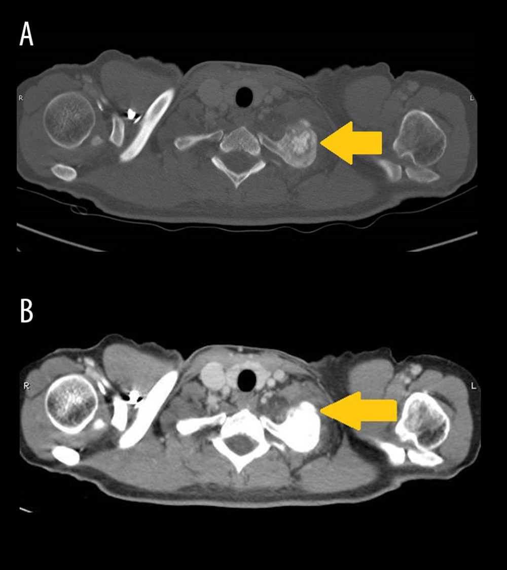 (A, B) CT scan of the chest showing a well-defined exophytic bony lesion with osseous matrix arising from the left first rib (arrows).