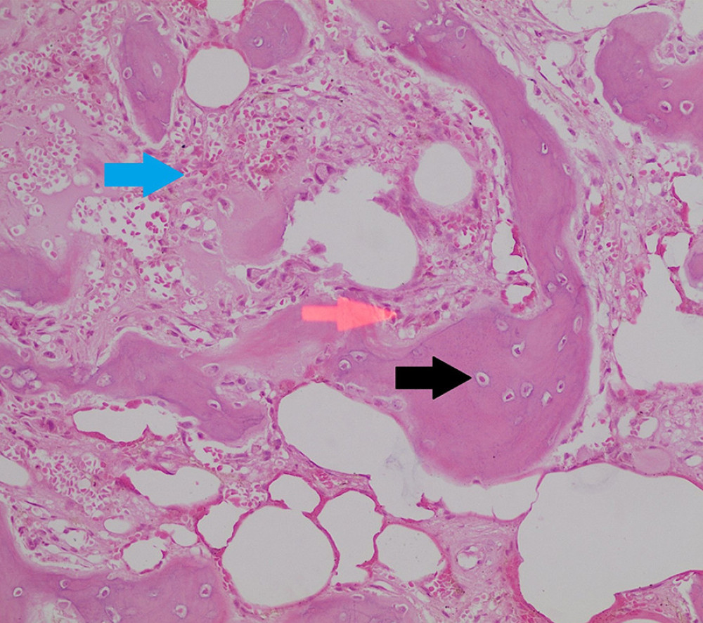 Microscopic examination (H&E stain with 20× magnification) shows bone a forming lesion composed of anastomosing irregular trabeculae (black arrow) with multiple foci of sclerotic nidus. The trabeculae are lined by a single layer of osteoblasts (red arrow) with intervening loose fibrovascular stroma (blue arrow). No evidence for cellular atypia, abnormal mitotic figures, or necrosis.